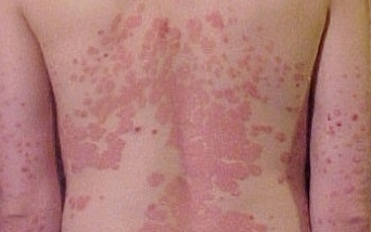 Fényterápiás kabin segíti a bőrbetegségek kezelését Pécsett